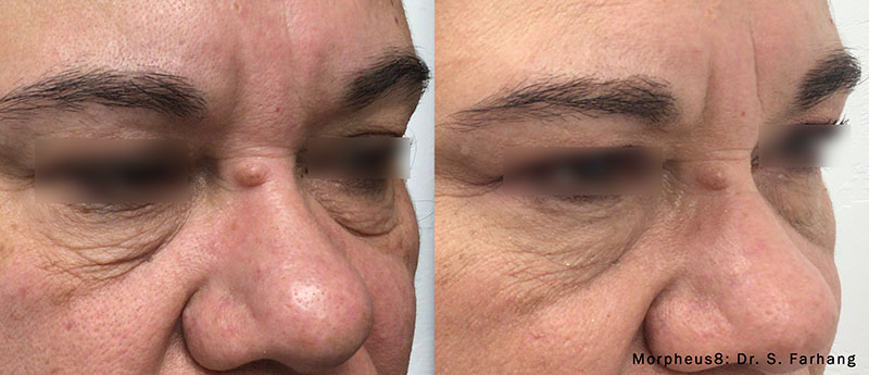 morpheus8 skin tightening soho nyc